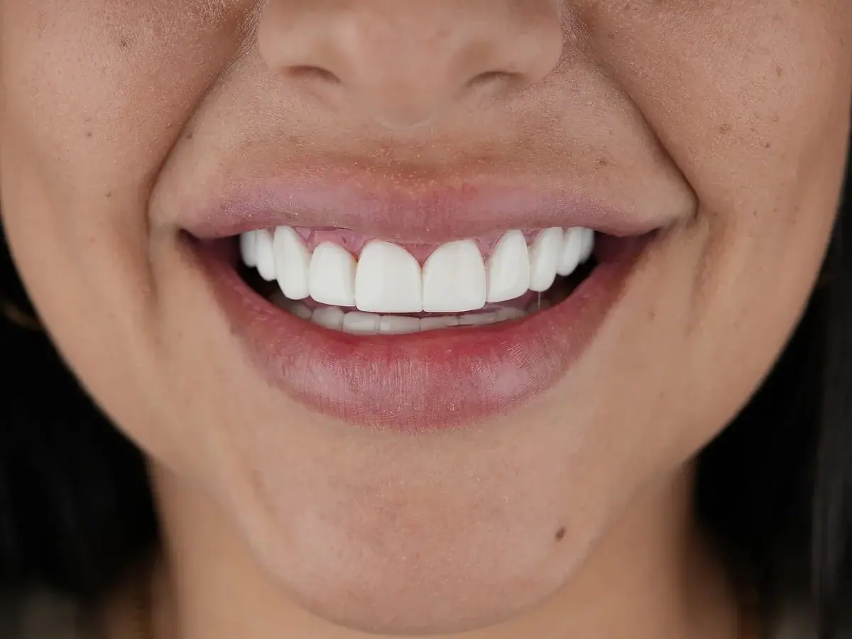 After composite veneers — real patient result at Smile Dental Center