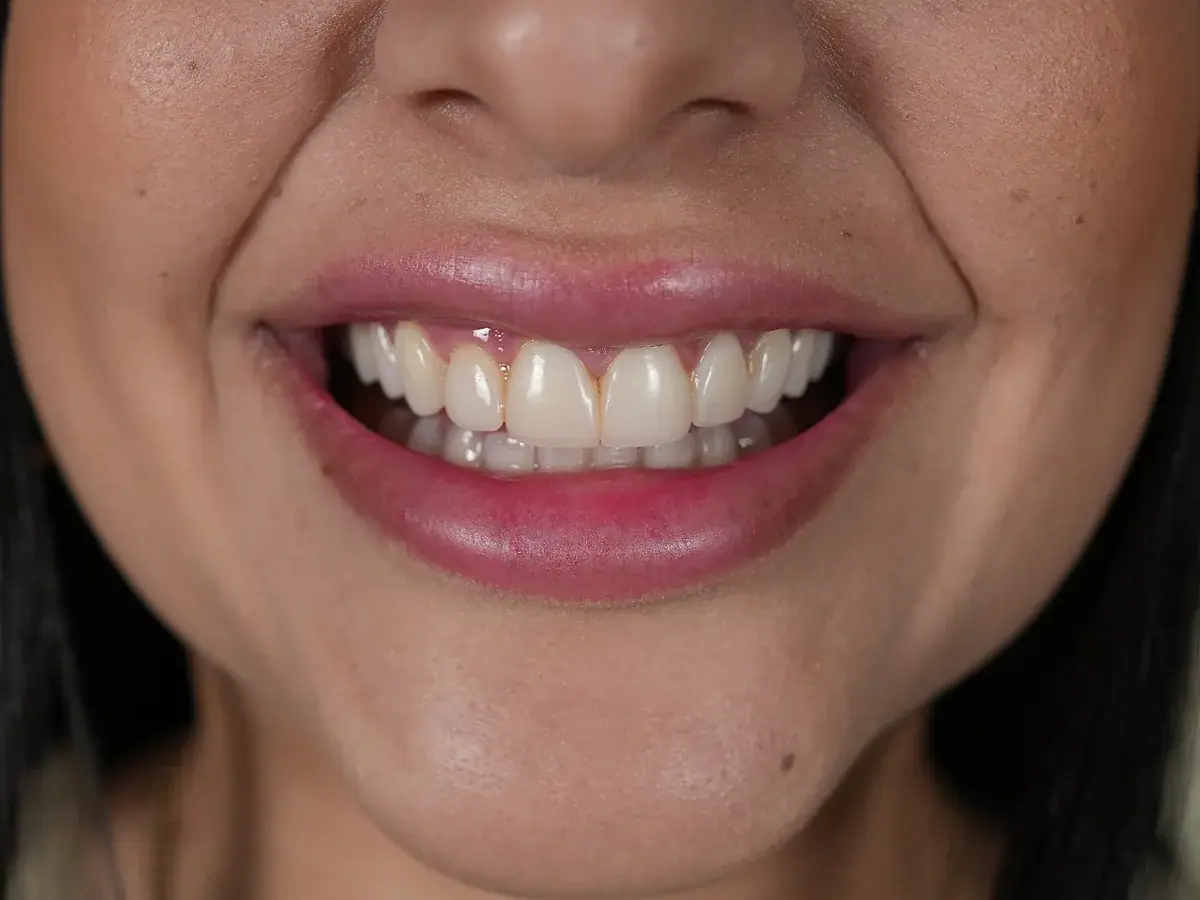 Before — Composite Veneers — Miami, FL