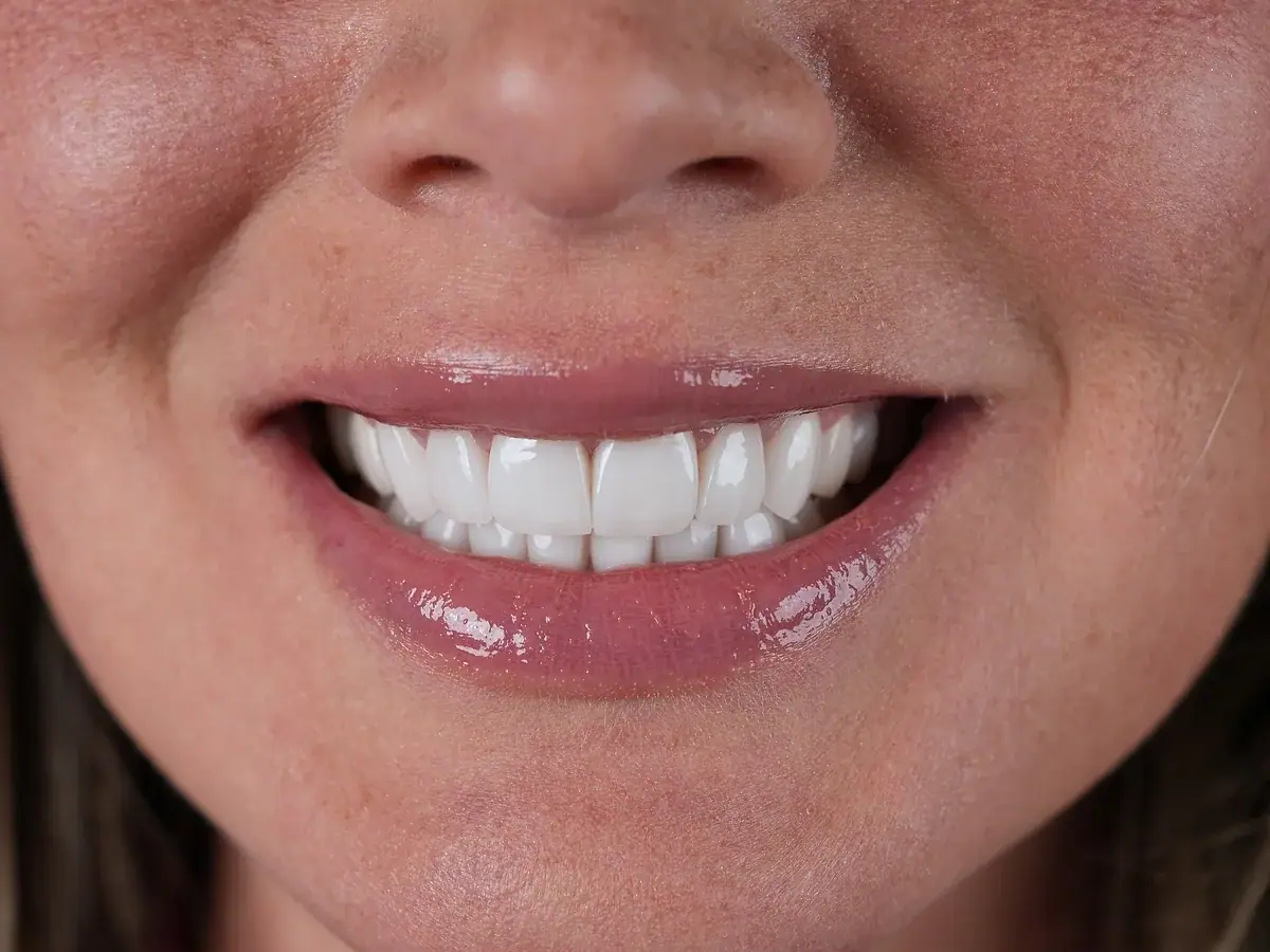 After porcelain veneers — real patient result at Smile Dental Center Miami