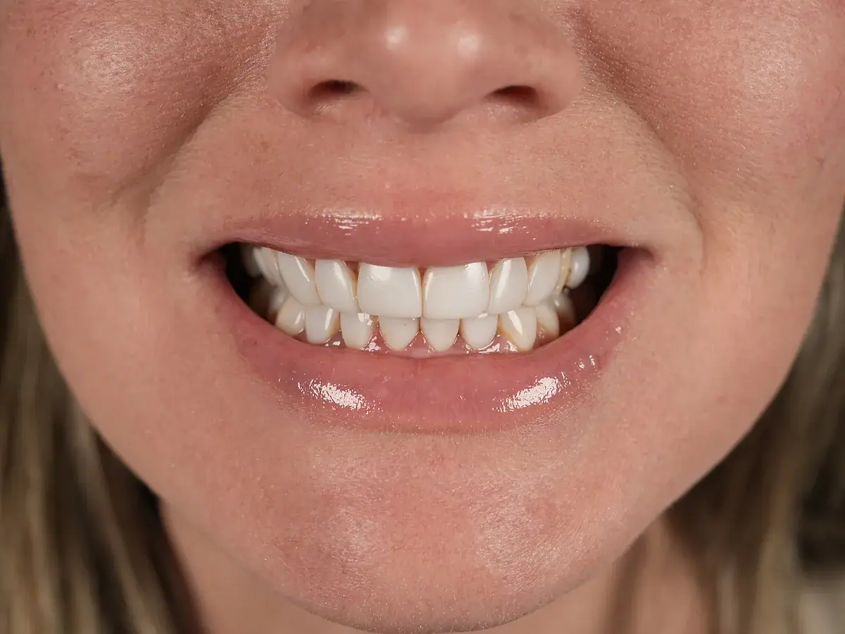 Before — Porcelain Veneers — Miami, FL
