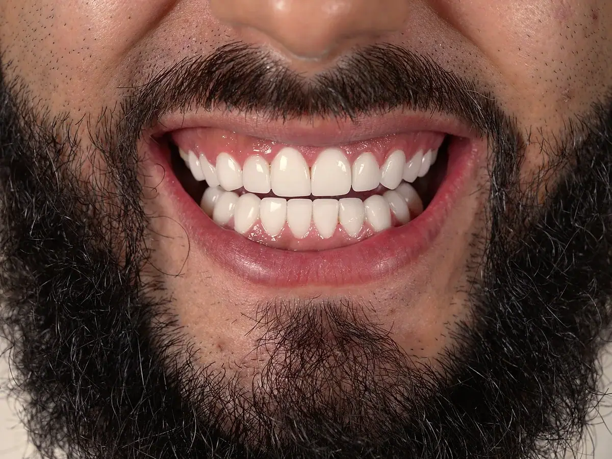 Real patient smile · Composite Veneers · Smile Dental Center Miami 4