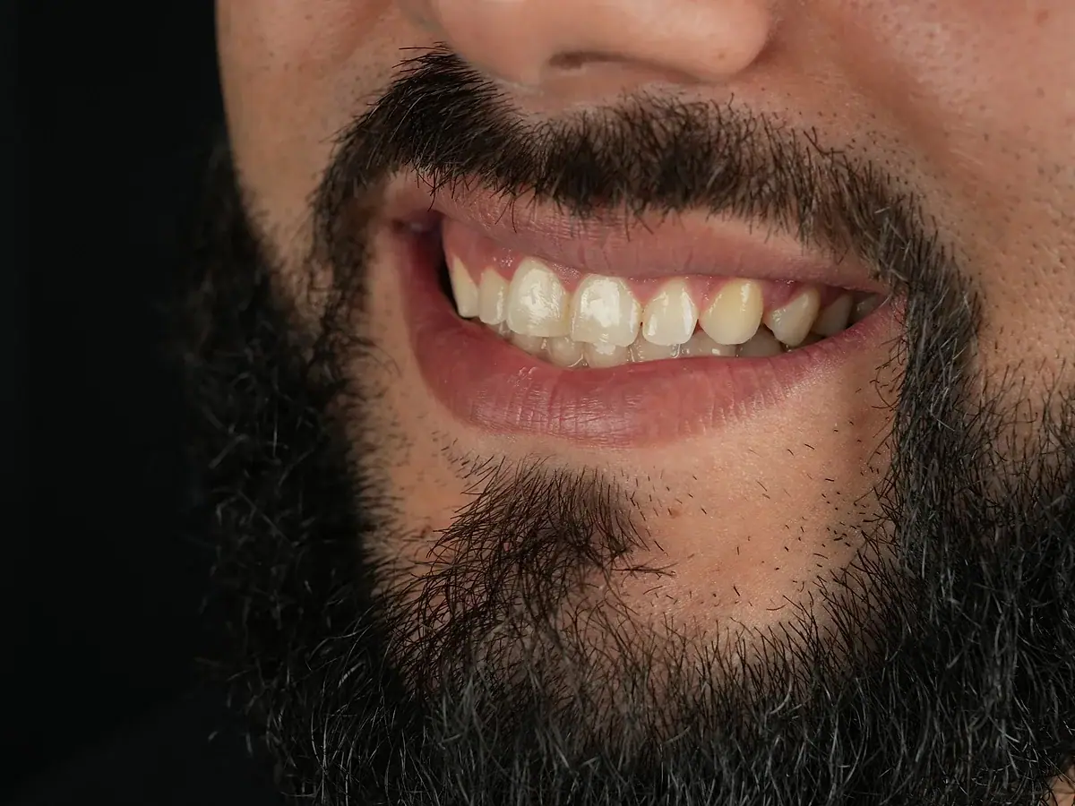 Smile before — Porcelain Smile Makeover
