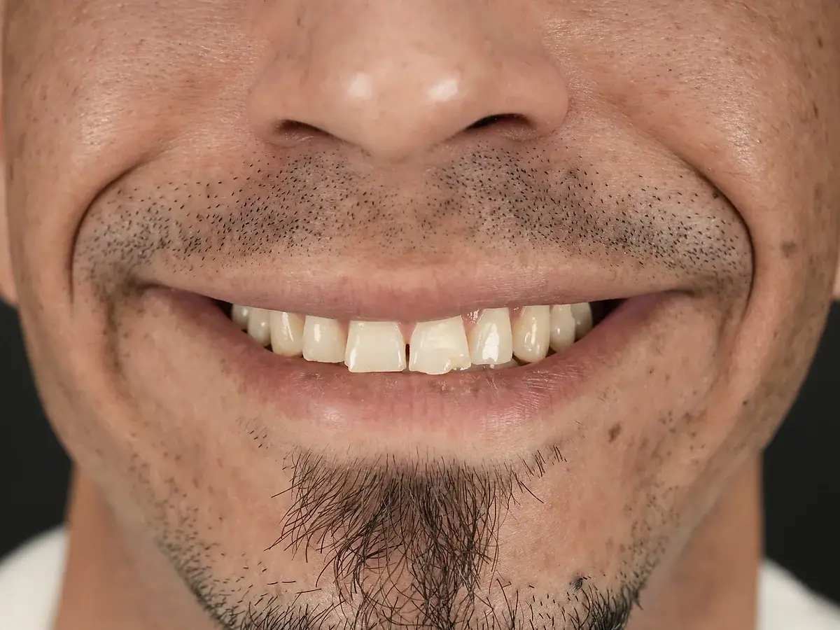 Smile before — Composite Veneers — Gap Closure