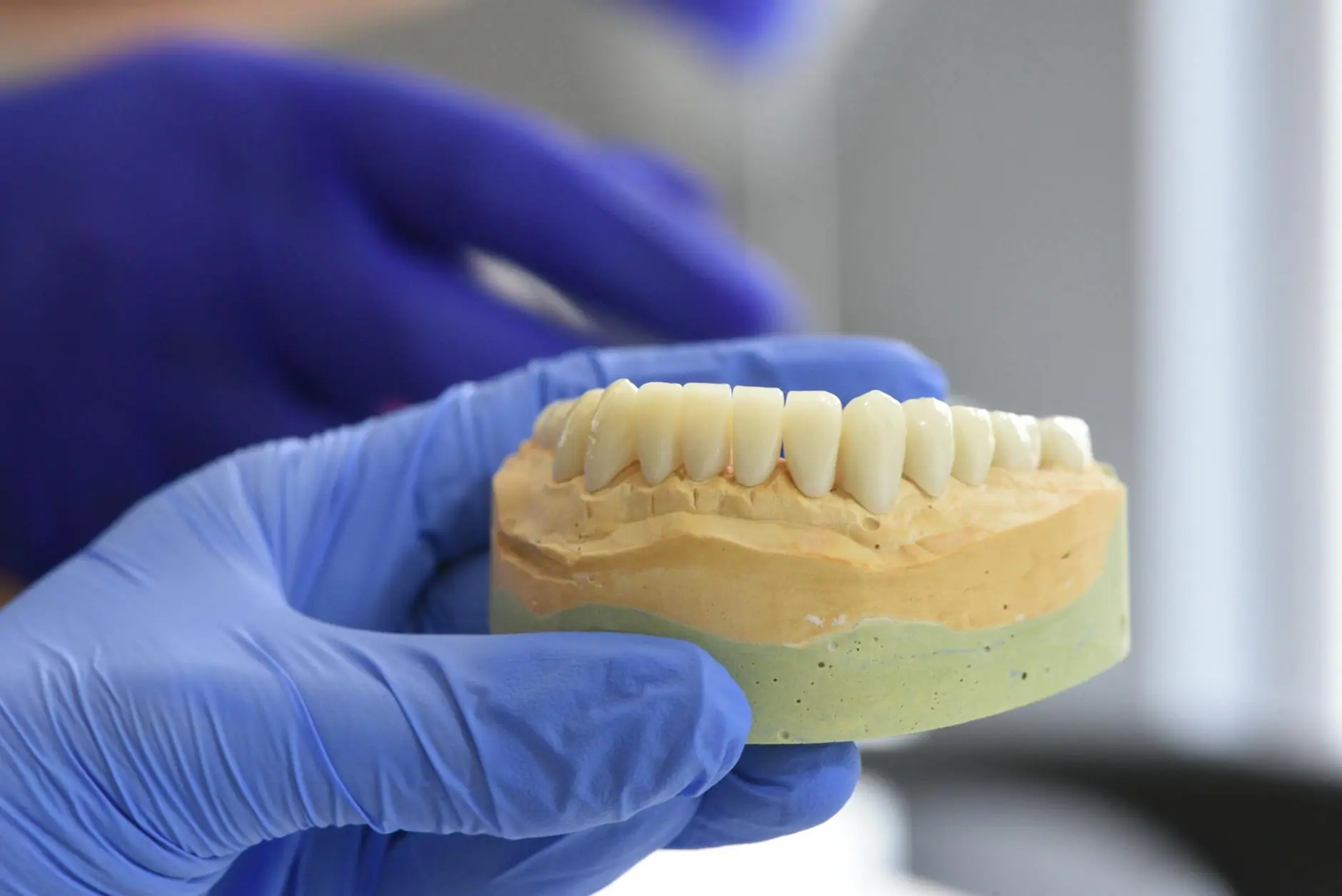 Full-arch dental implant treatment · Smile Dental Center Miami 5