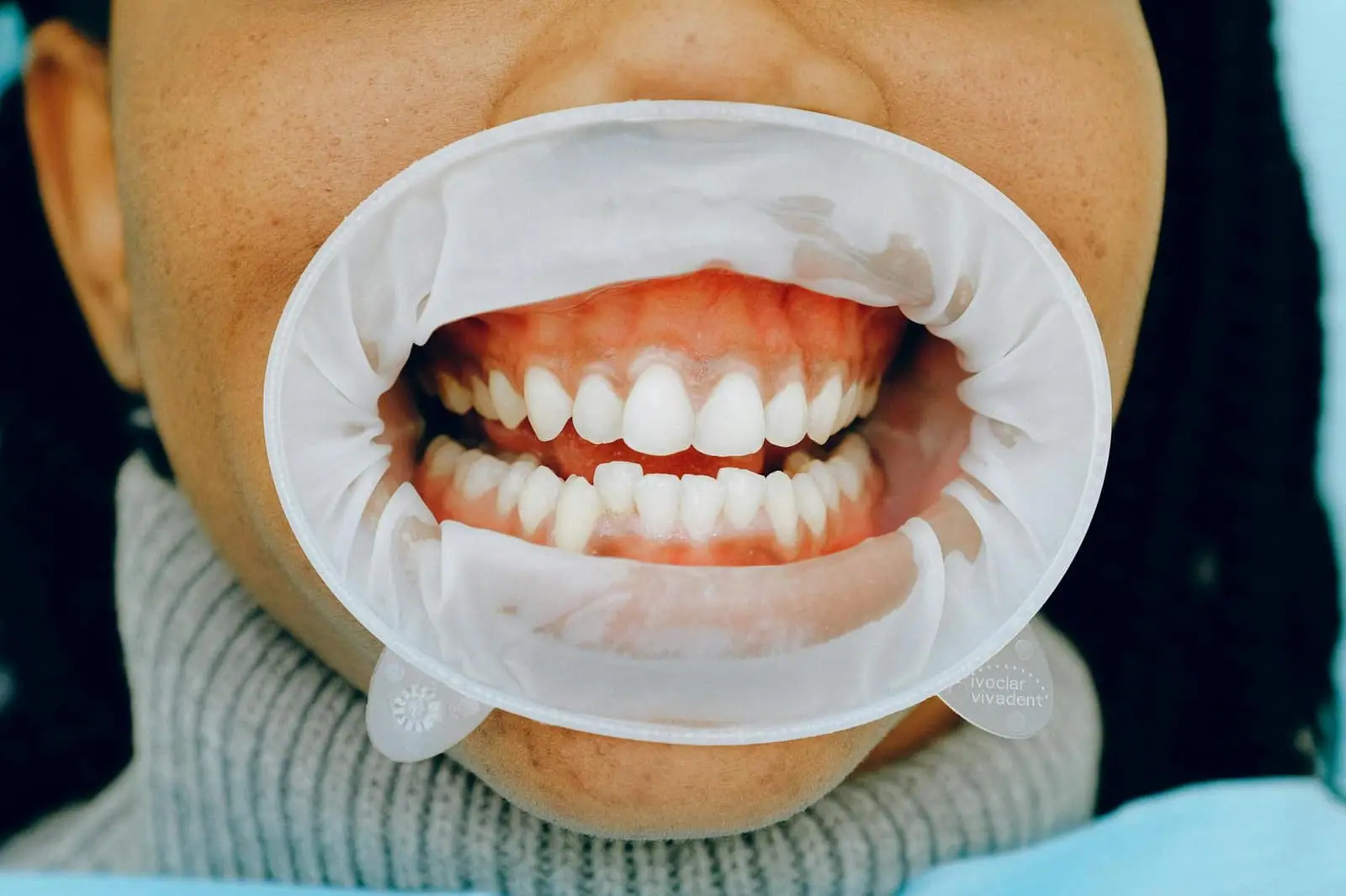 How to Fix Black Triangles Between Teeth