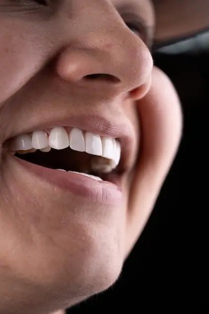 Smile makeover close-up — Smile Dental Center Medellín