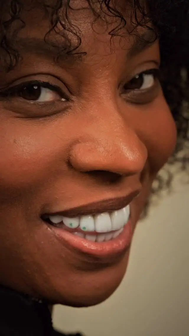 Porcelain veneers result shared on Instagram — Smile Dental Center