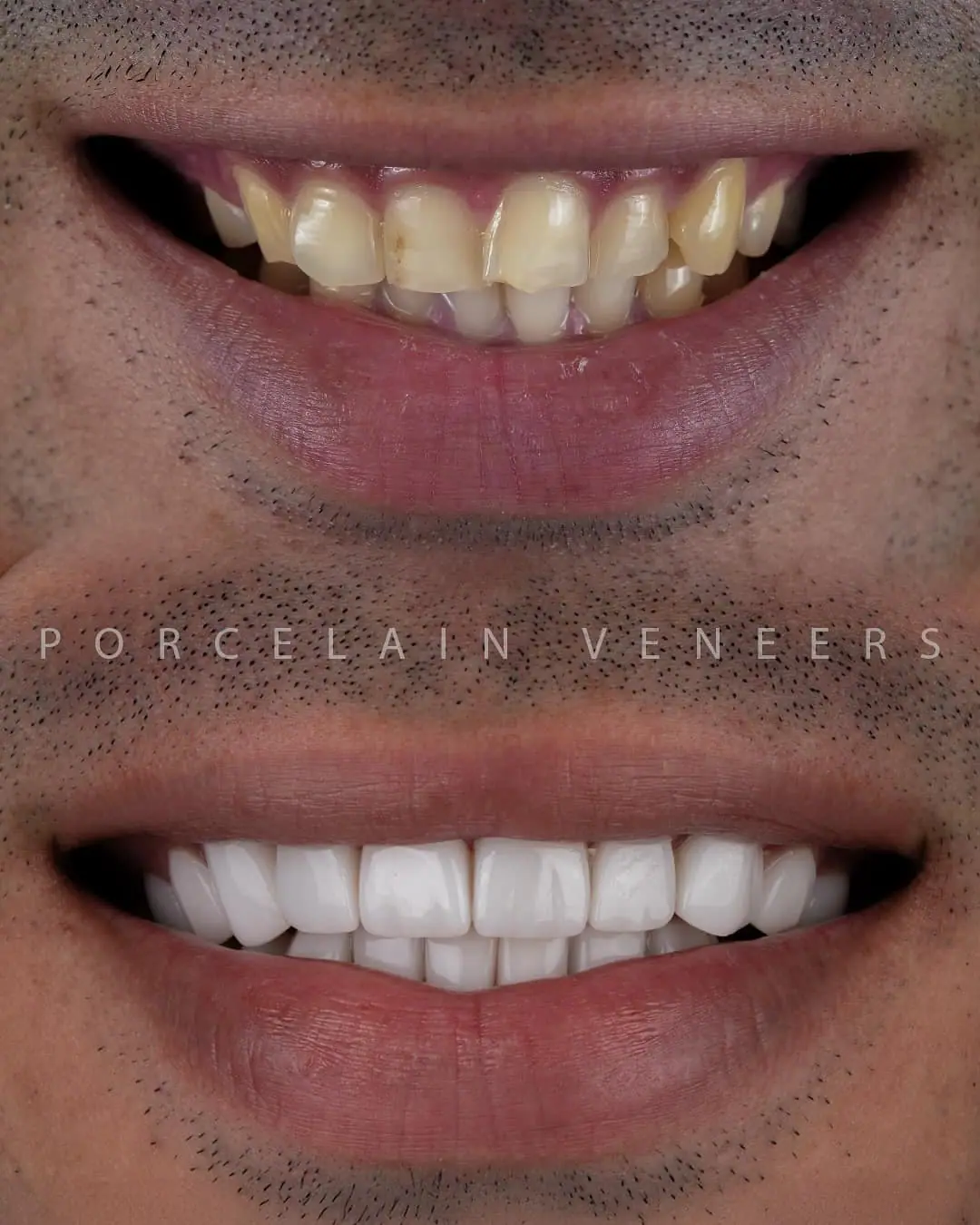 New smile reveal — Smile Dental Center Miami