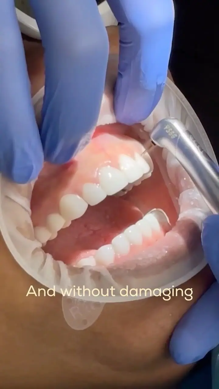 Smile transformation shared on Instagram — Smile Dental Center