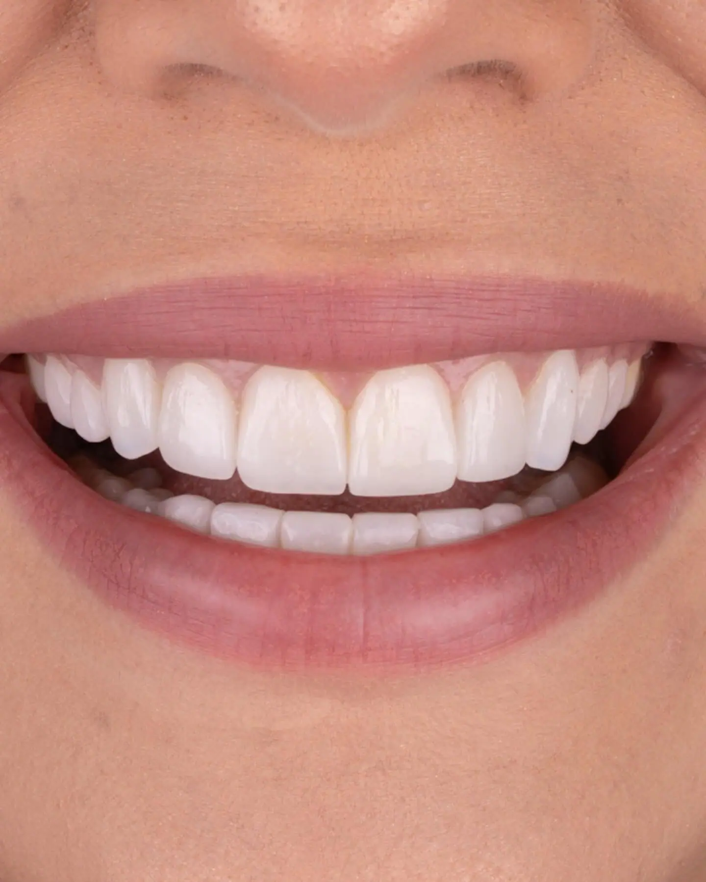 Smile makeover close-up — Smile Dental Center