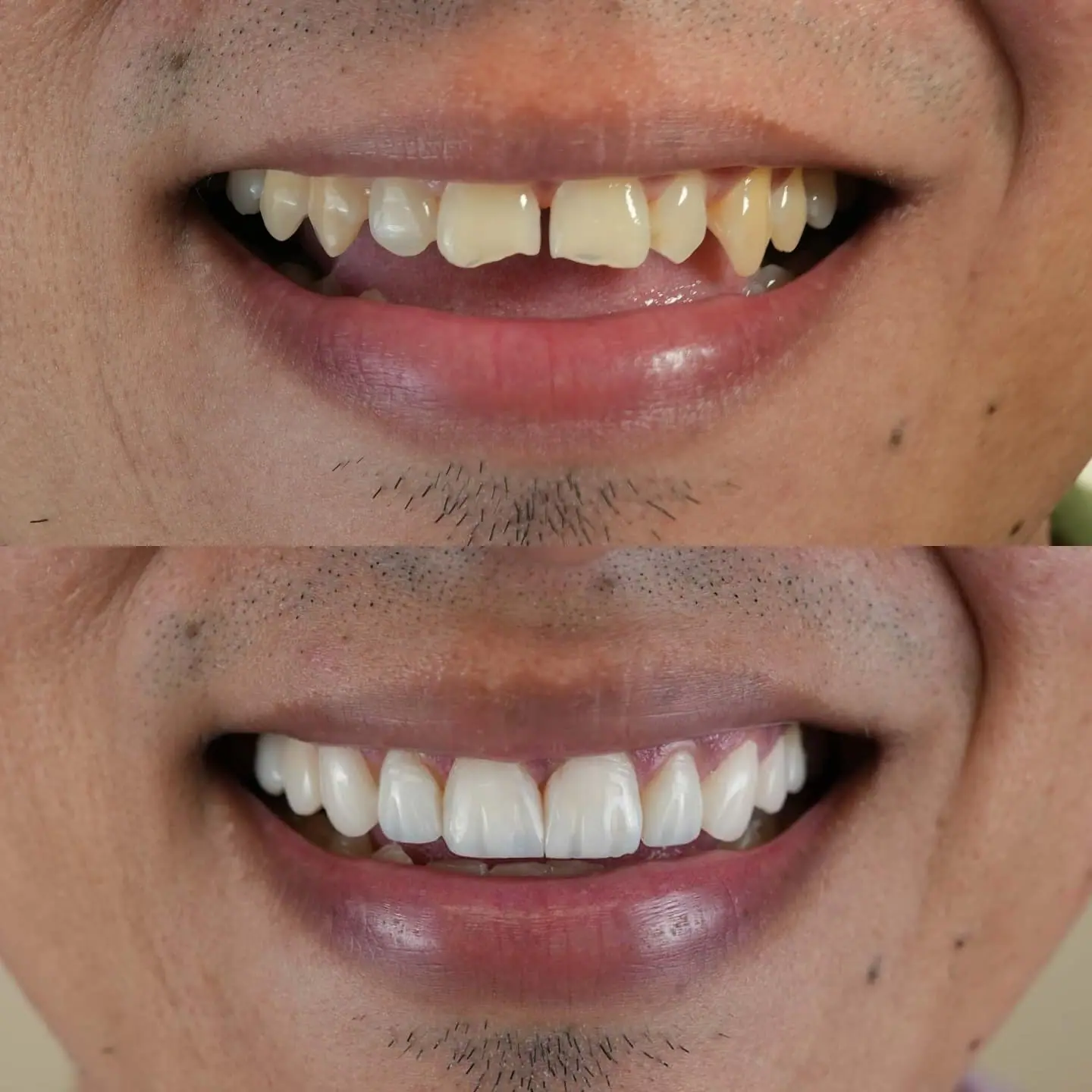 Smile makeover result — Smile Dental Center patient