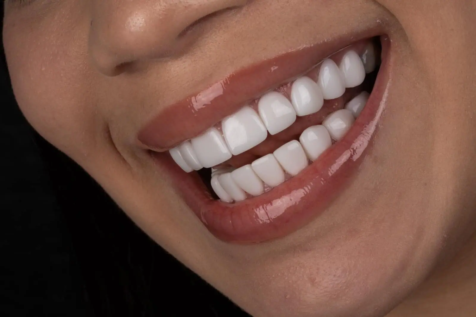 Composite veneers smile makeover — Smile Dental Center Miami