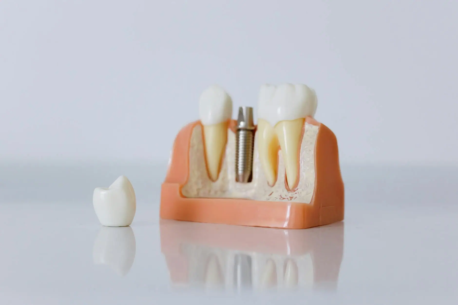 Dental Implants Miami