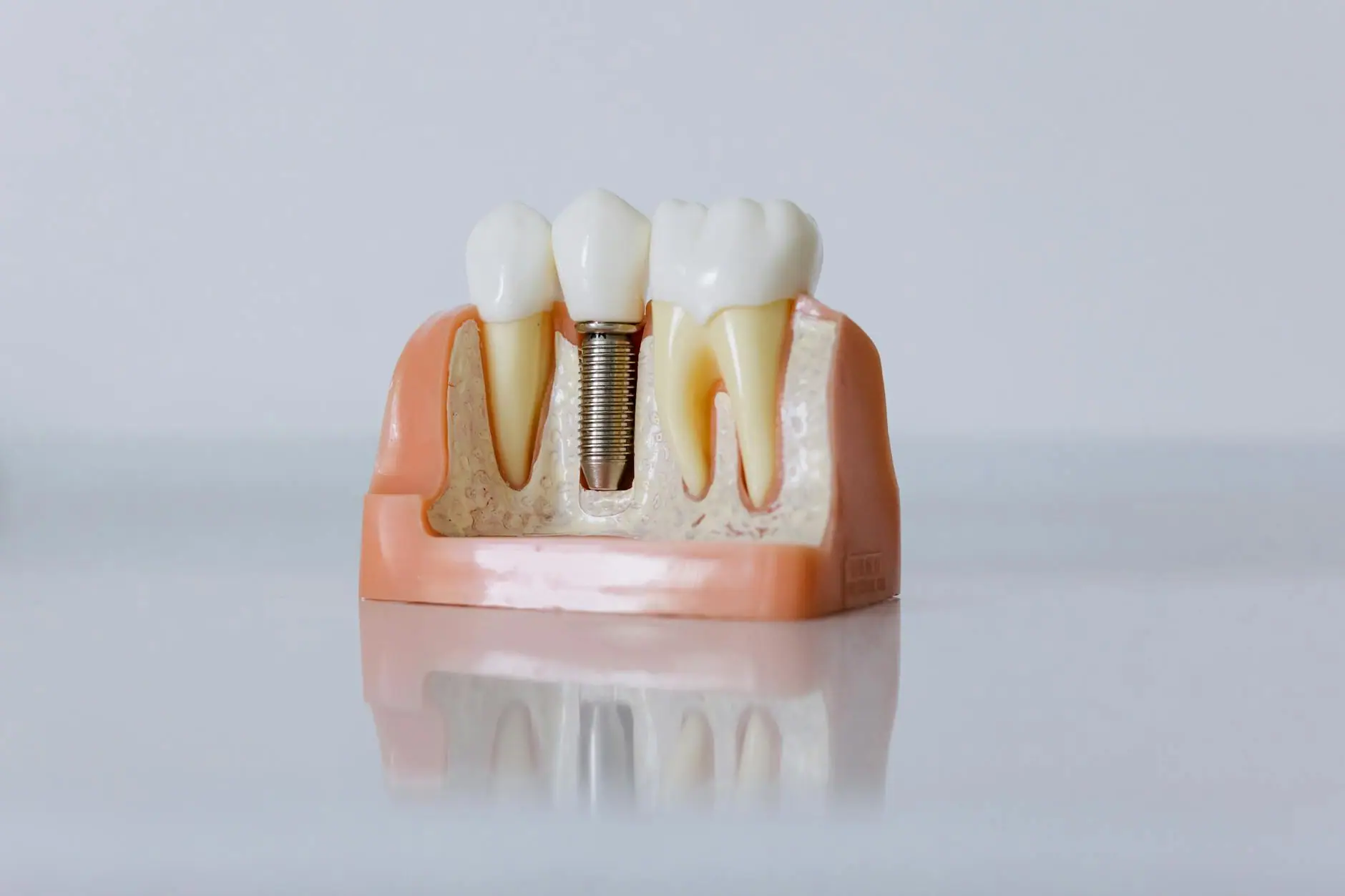 Dental implant treatment · Smile Dental Center Miami 2
