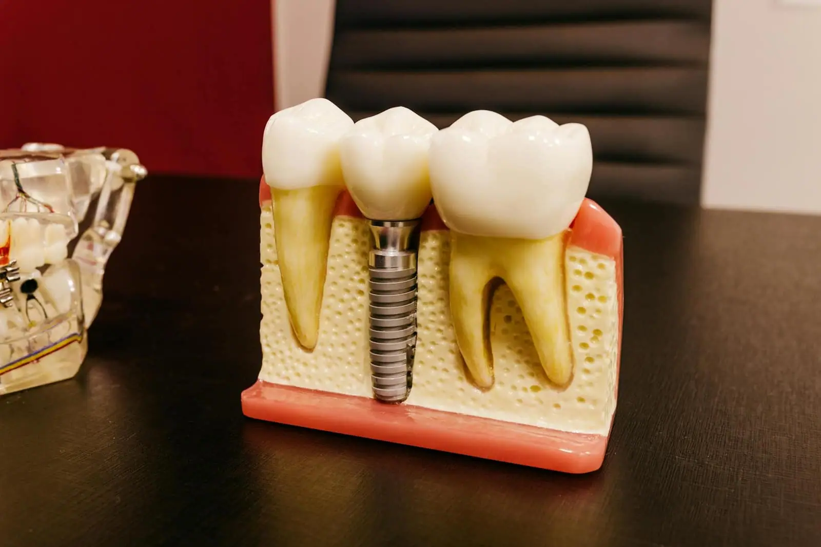 Dental implant treatment · Smile Dental Center Miami 3