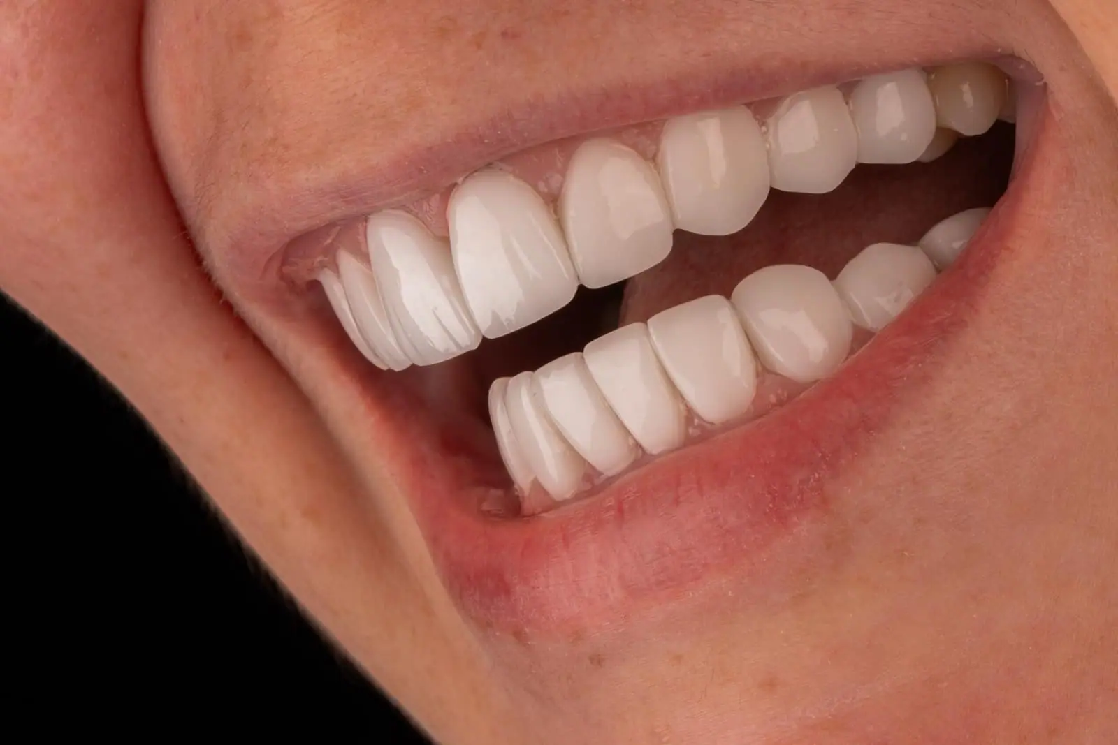 Porcelain veneers patient smile — Smile Dental Center Miami